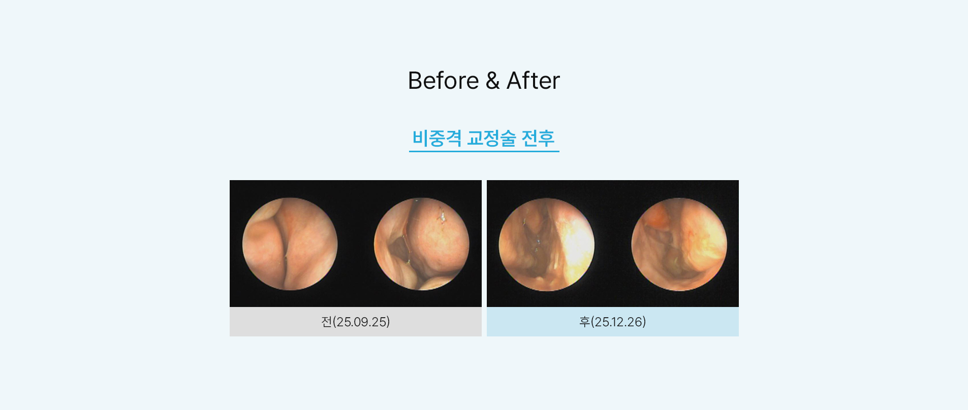 비중격 교정술 전후