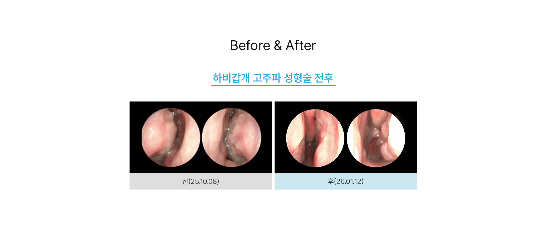 하비갑개 고주파 성형술 전후
